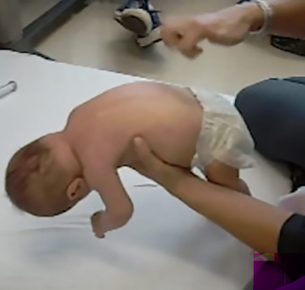 Infant spinal muscular atrophy patient showing a sign of SMA called floppy baby syndrome
