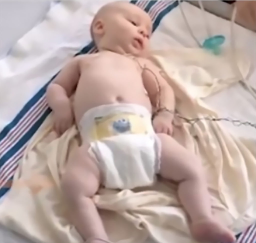 Infant with spinal muscular atrophy showing a sign of SMA called frog-leg position