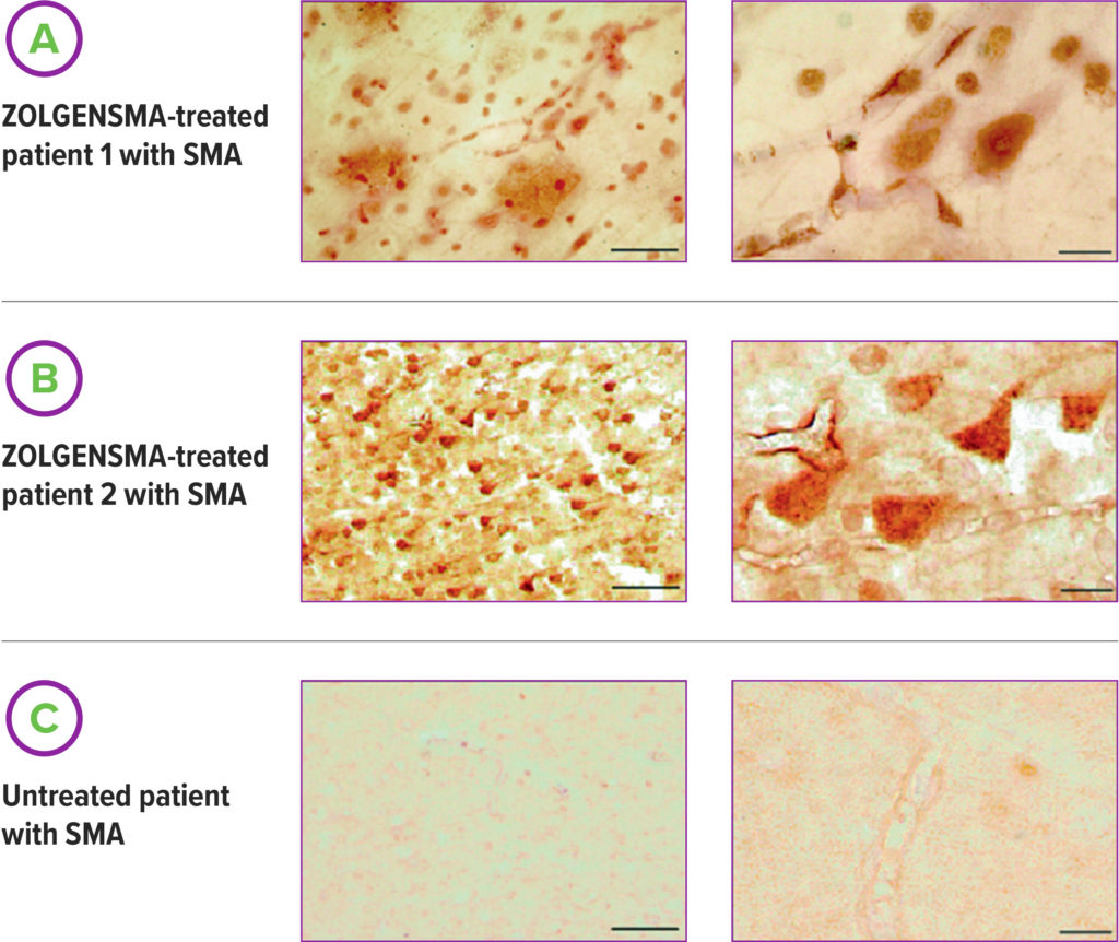 SMN protein expression in the central nervous system (CNS) and in motor neurons in ZOLGENSMA-treated patients